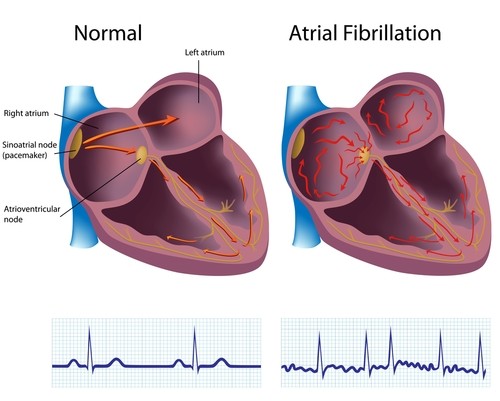 Brief visual info of Atrial Fibrillation in comparison with a normal heartbeat. (Credit: CDC)