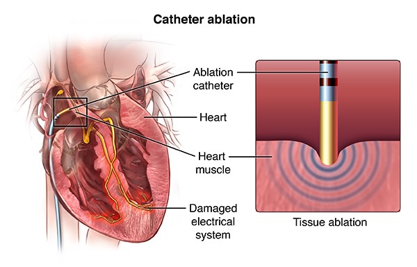 Cardiac ablation overview. (Credit: University Chicago Medical)