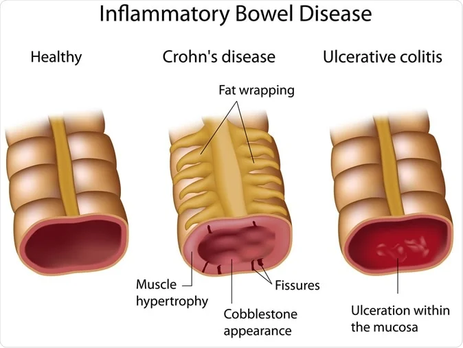 Comparison between health large intestines and those with IBD (Alila Medical Media / Shutterstock)
