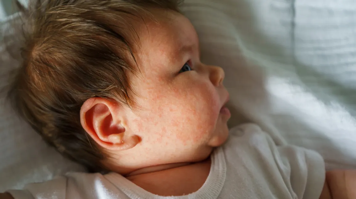 Infant with atopic dermatitis (Miljan Živković/Getty Images)